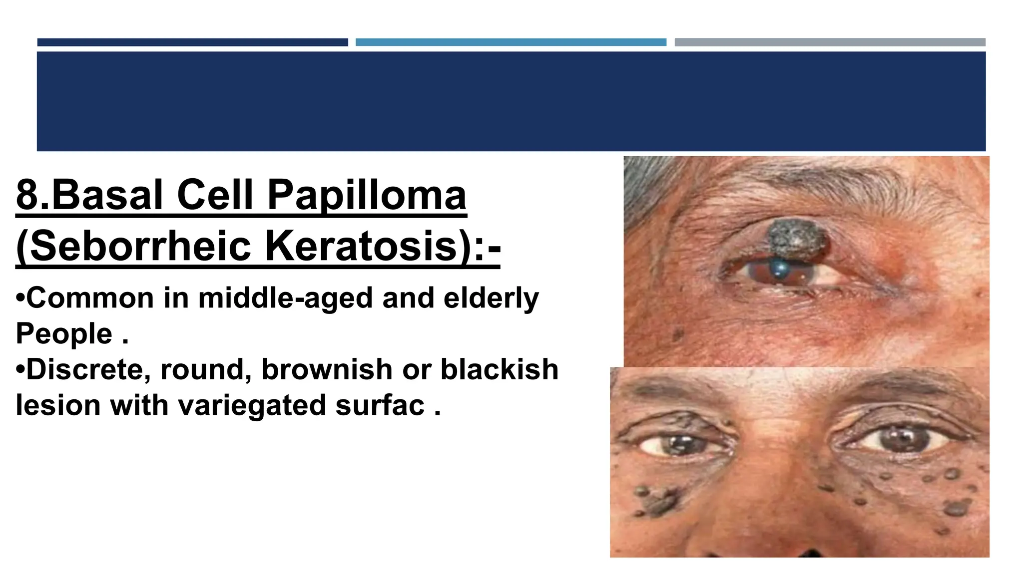 Diseases of eyelids like Epicanthus, entropian, ectropian, Telecanthus ...