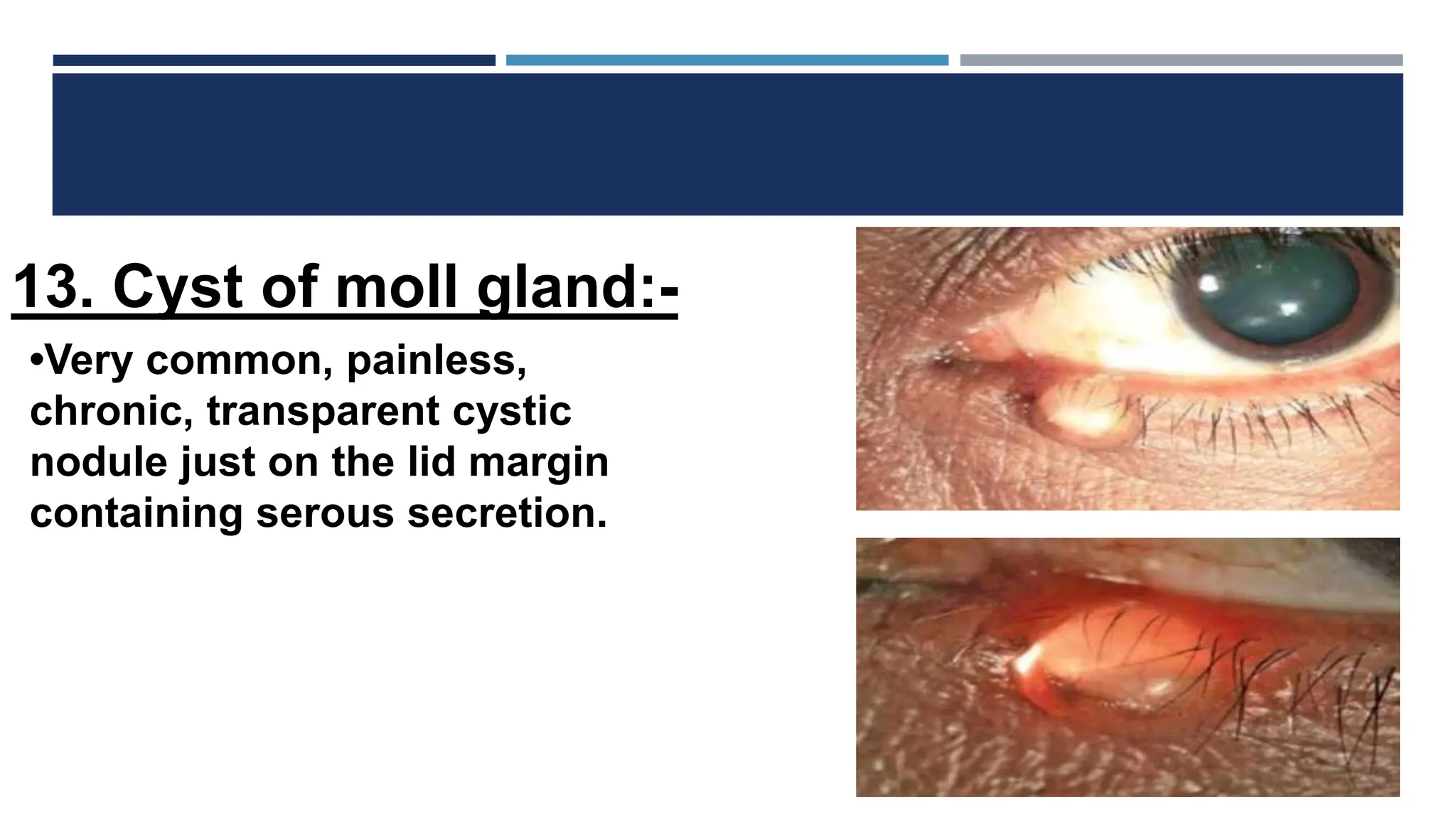 Diseases of eyelids like Epicanthus, entropian, ectropian, Telecanthus ...
