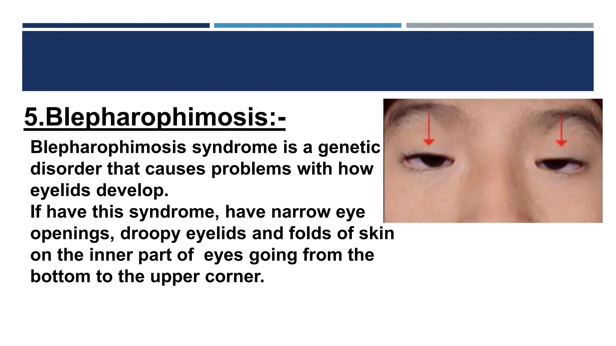 Diseases of eyelids like Epicanthus, entropian, ectropian, Telecanthus ...