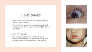 Comprehensive Overview of Eyelid Diseases and Disorders | PPTX