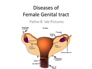 Diseases of Female Genital tract  Patho-B  lab Pictures 