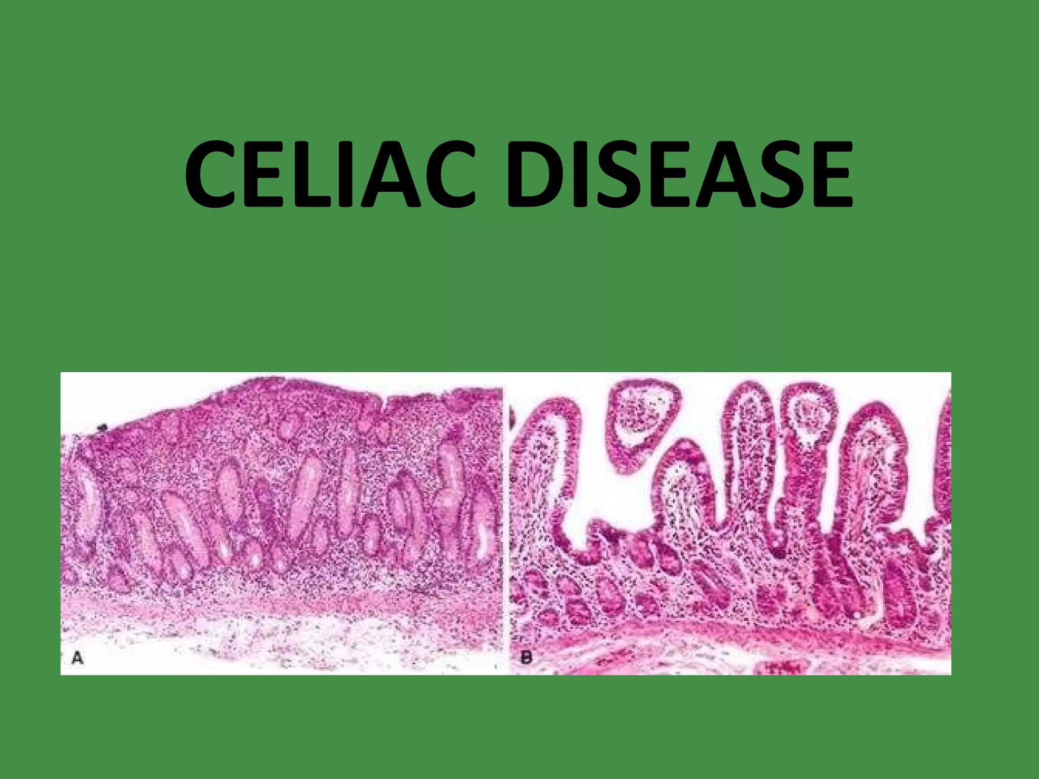 CELIAC DISEASE 