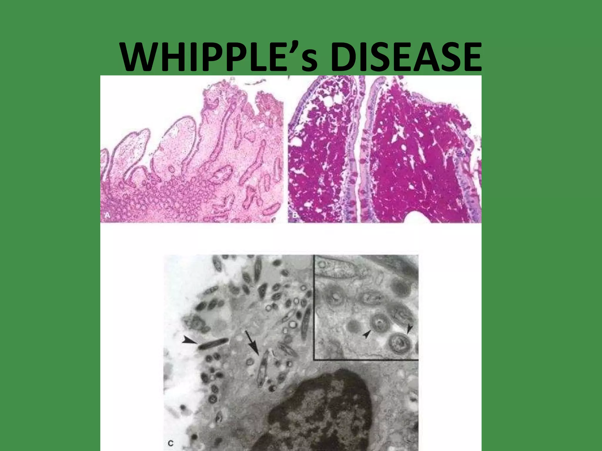 WHIPPLE’s DISEASE 