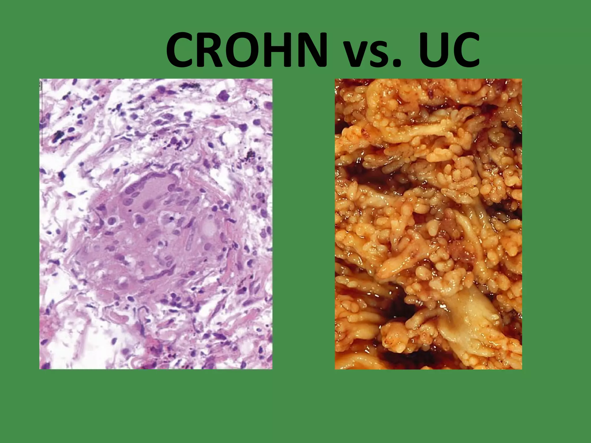CROHN vs. UC 
