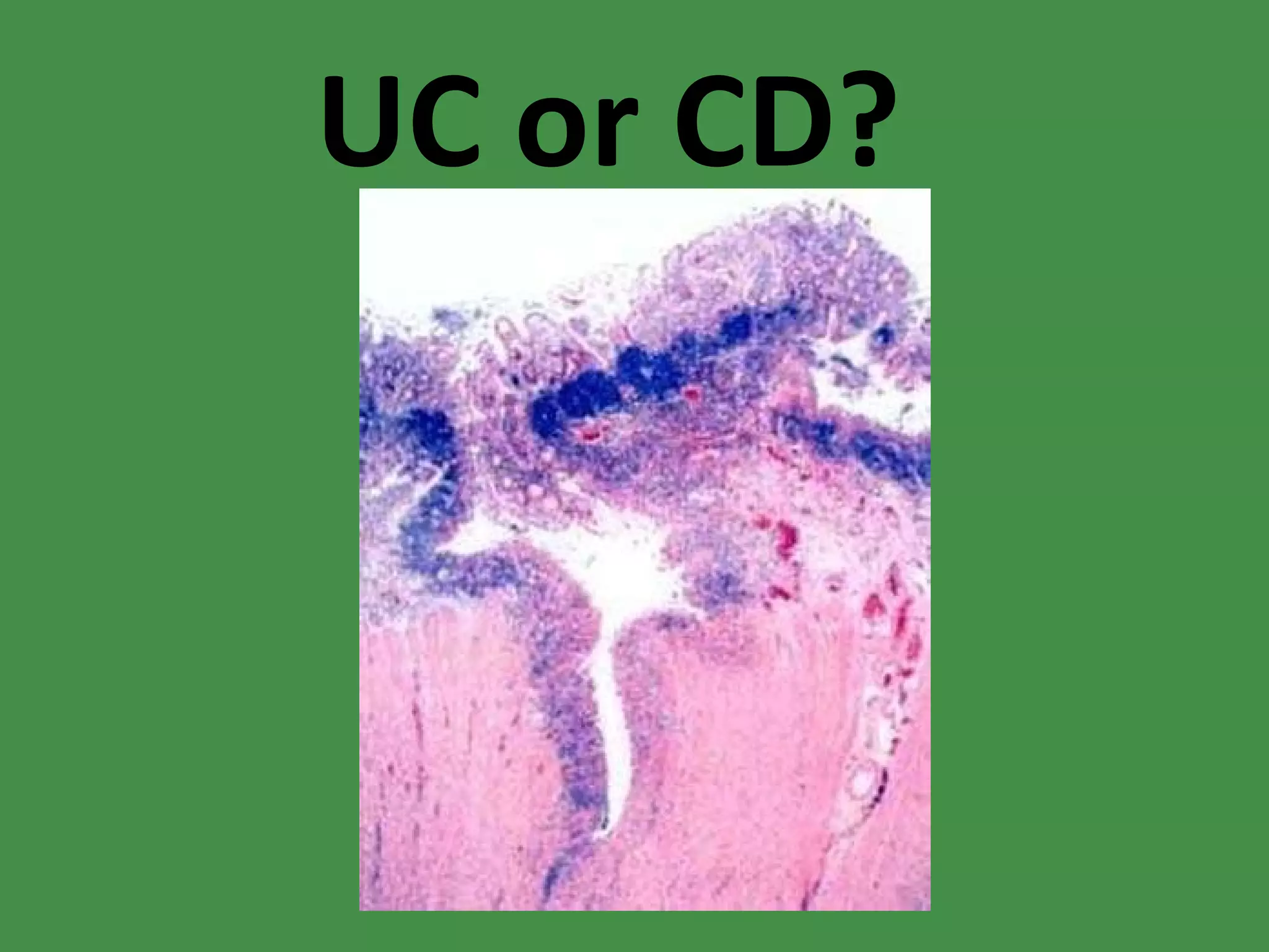 UC or CD? 