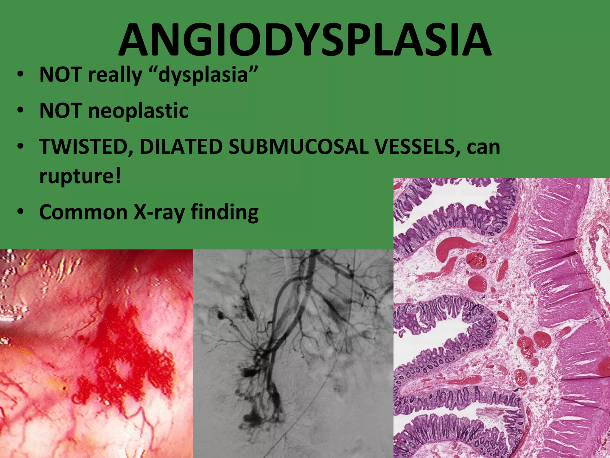 ANGIODYSPLASIA NOT really “dysplasia” NOT neoplastic TWISTED, DILATED SUBMUCOSAL VESSELS, can rupture! Common X-ray finding 
