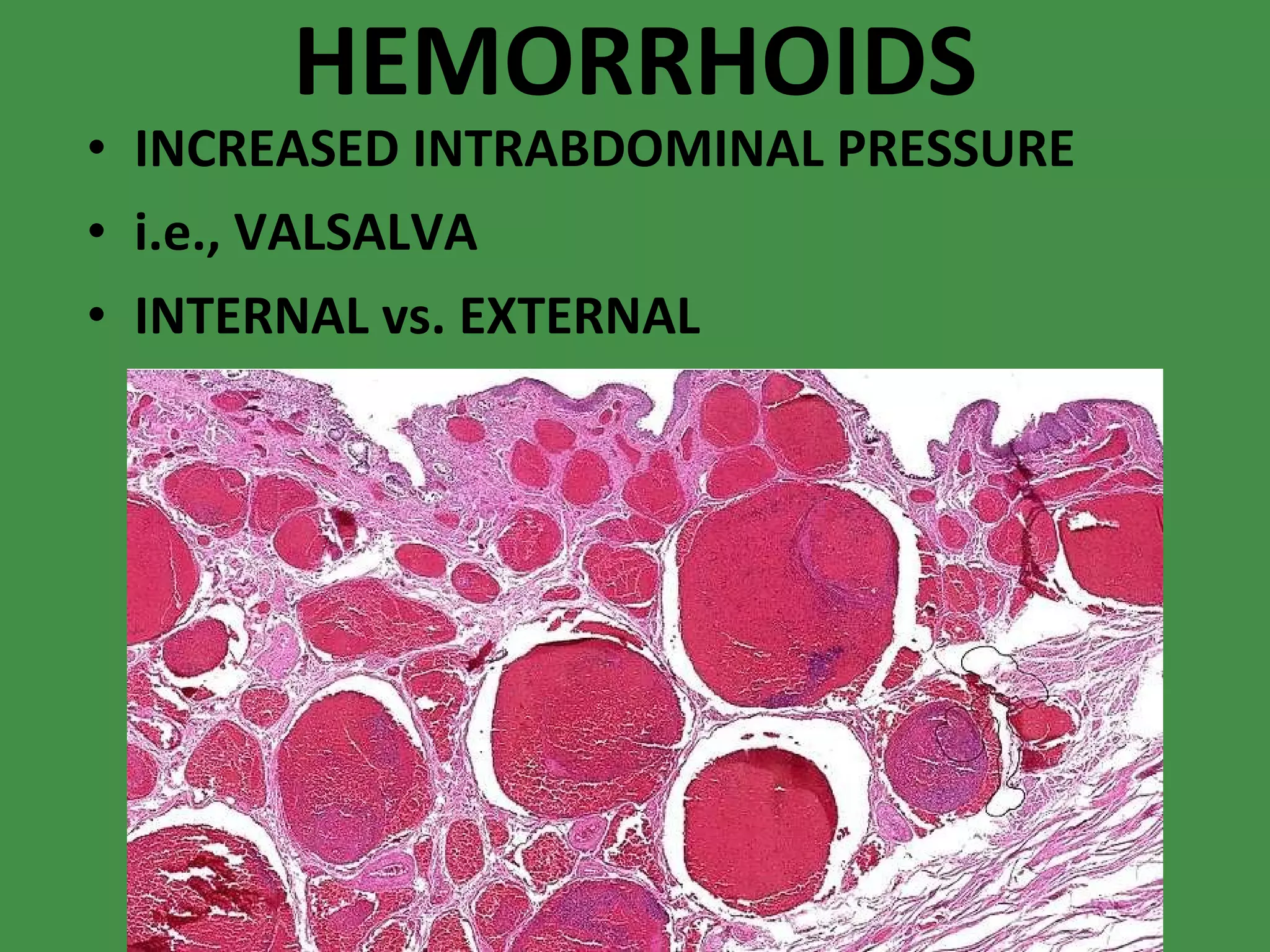 HEMORRHOIDS INCREASED INTRABDOMINAL PRESSURE i.e., VALSALVA INTERNAL vs. EXTERNAL 