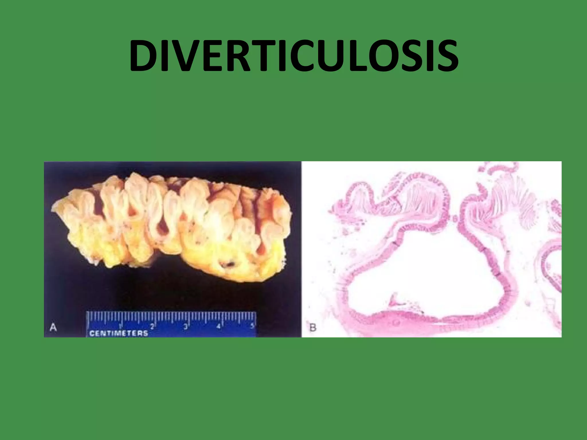 DIVERTICULOSIS 