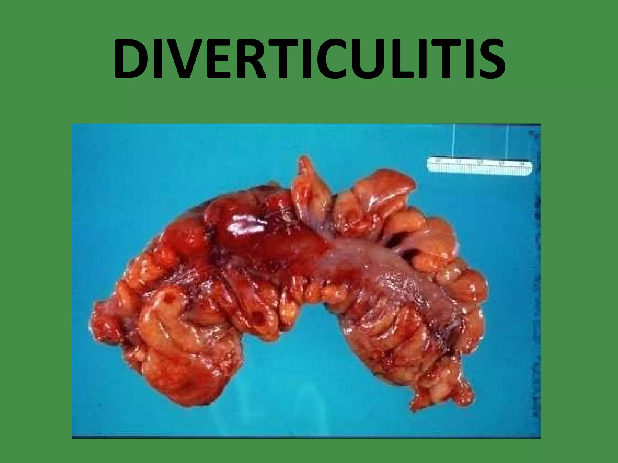 DIVERTICULITIS 