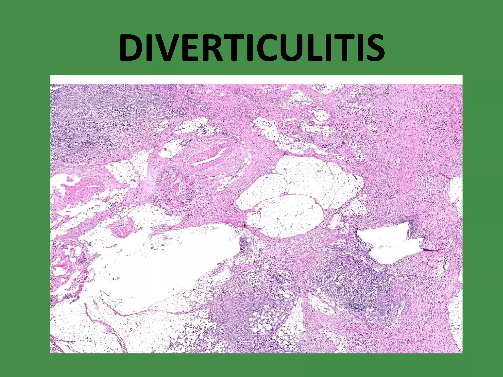 DIVERTICULITIS 
