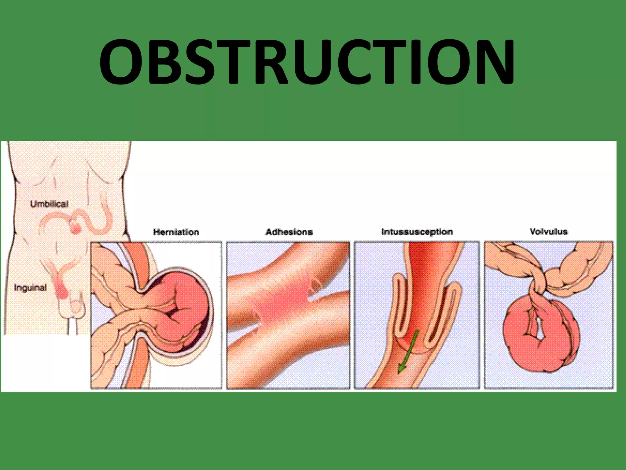 OBSTRUCTION 