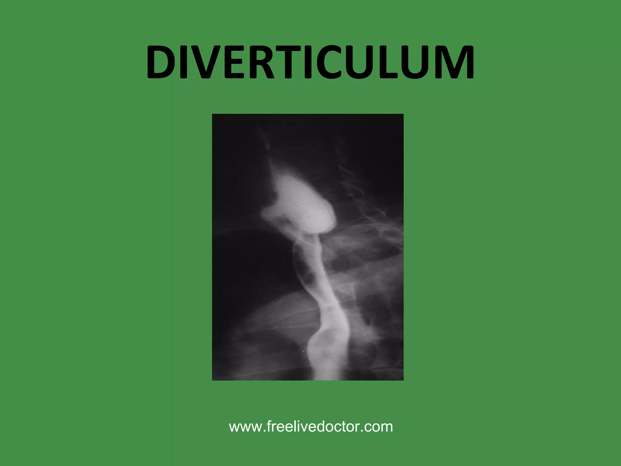 DIVERTICULUM www.freelivedoctor.com 
