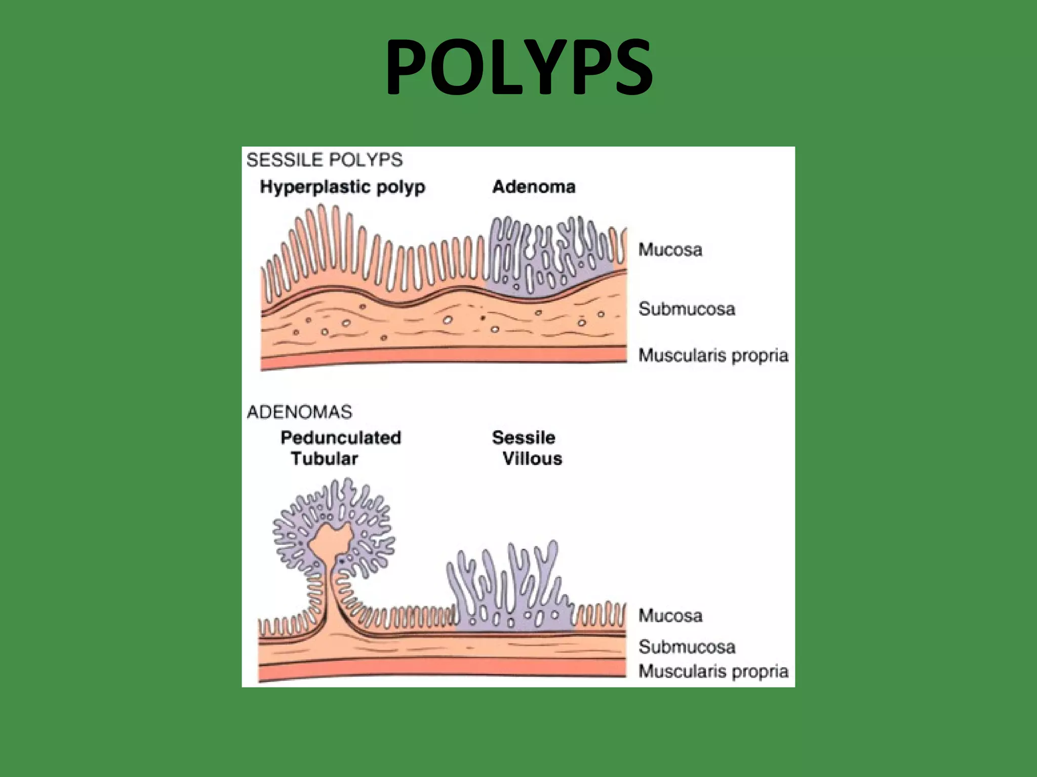 POLYPS 