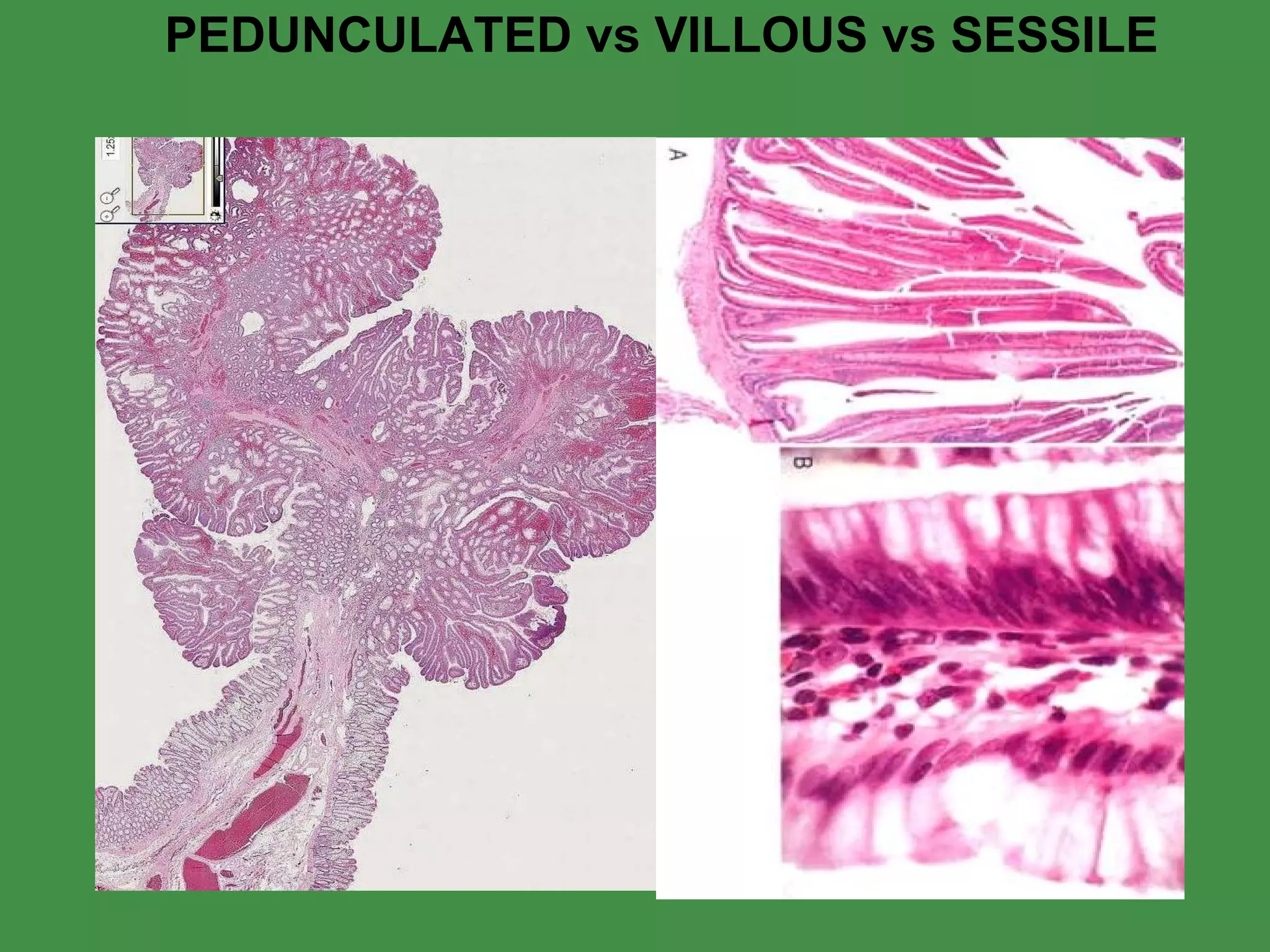 PEDUNCULATED vs VILLOUS vs SESSILE 
