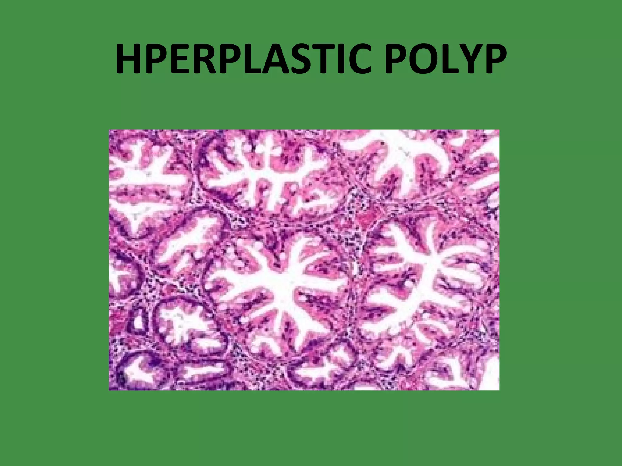HPERPLASTIC POLYP 