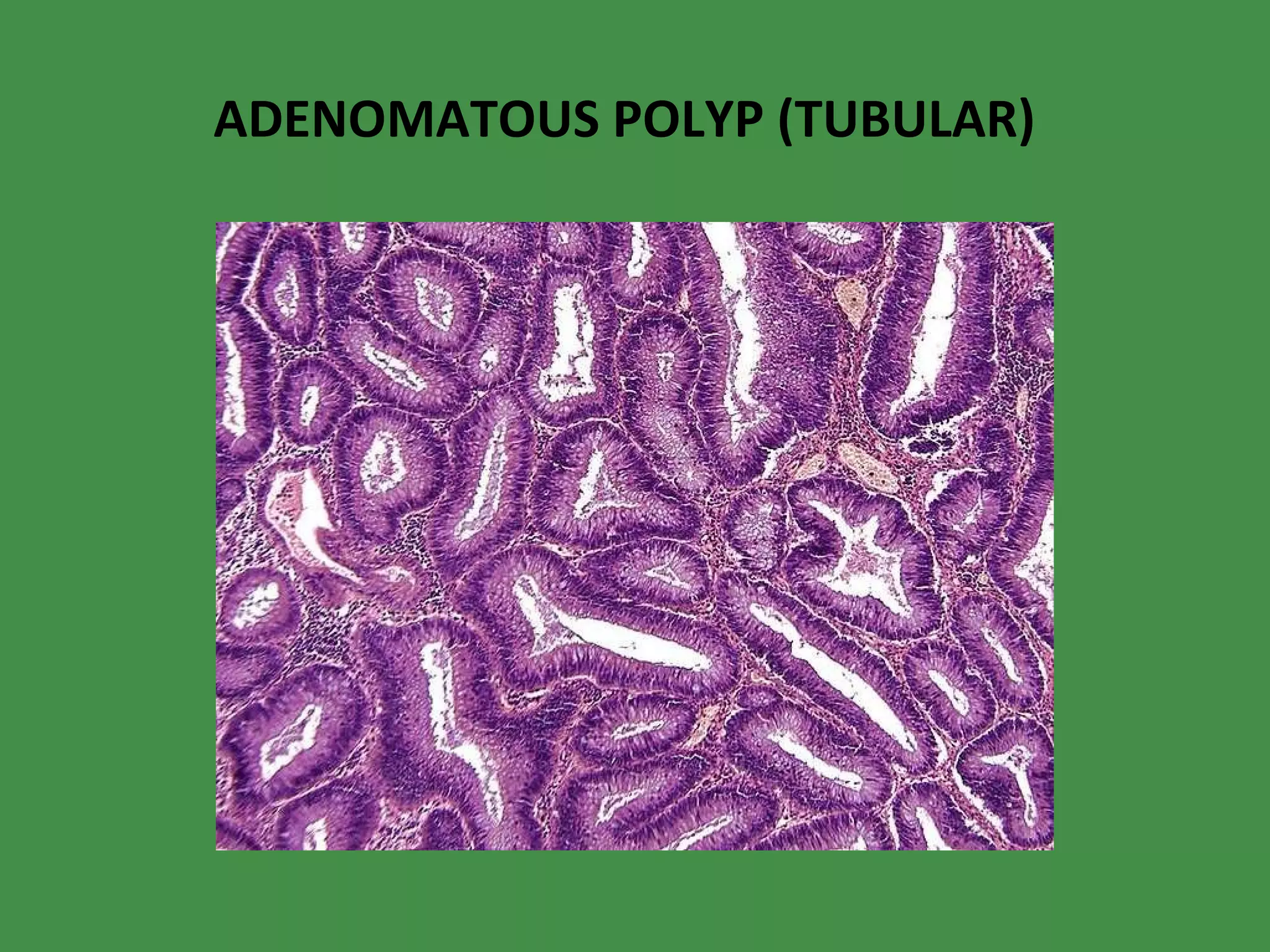 ADENOMATOUS POLYP (TUBULAR) 