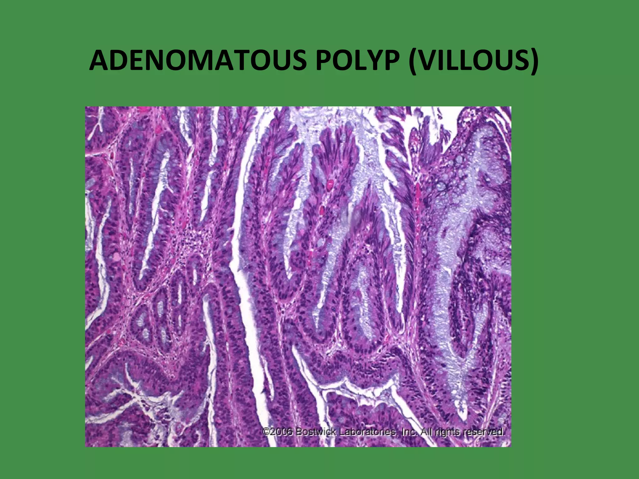 ADENOMATOUS POLYP (VILLOUS) 