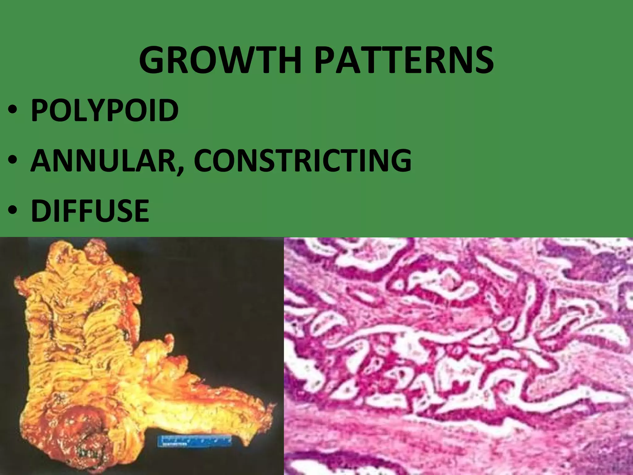 GROWTH PATTERNS POLYPOID ANNULAR, CONSTRICTING DIFFUSE 