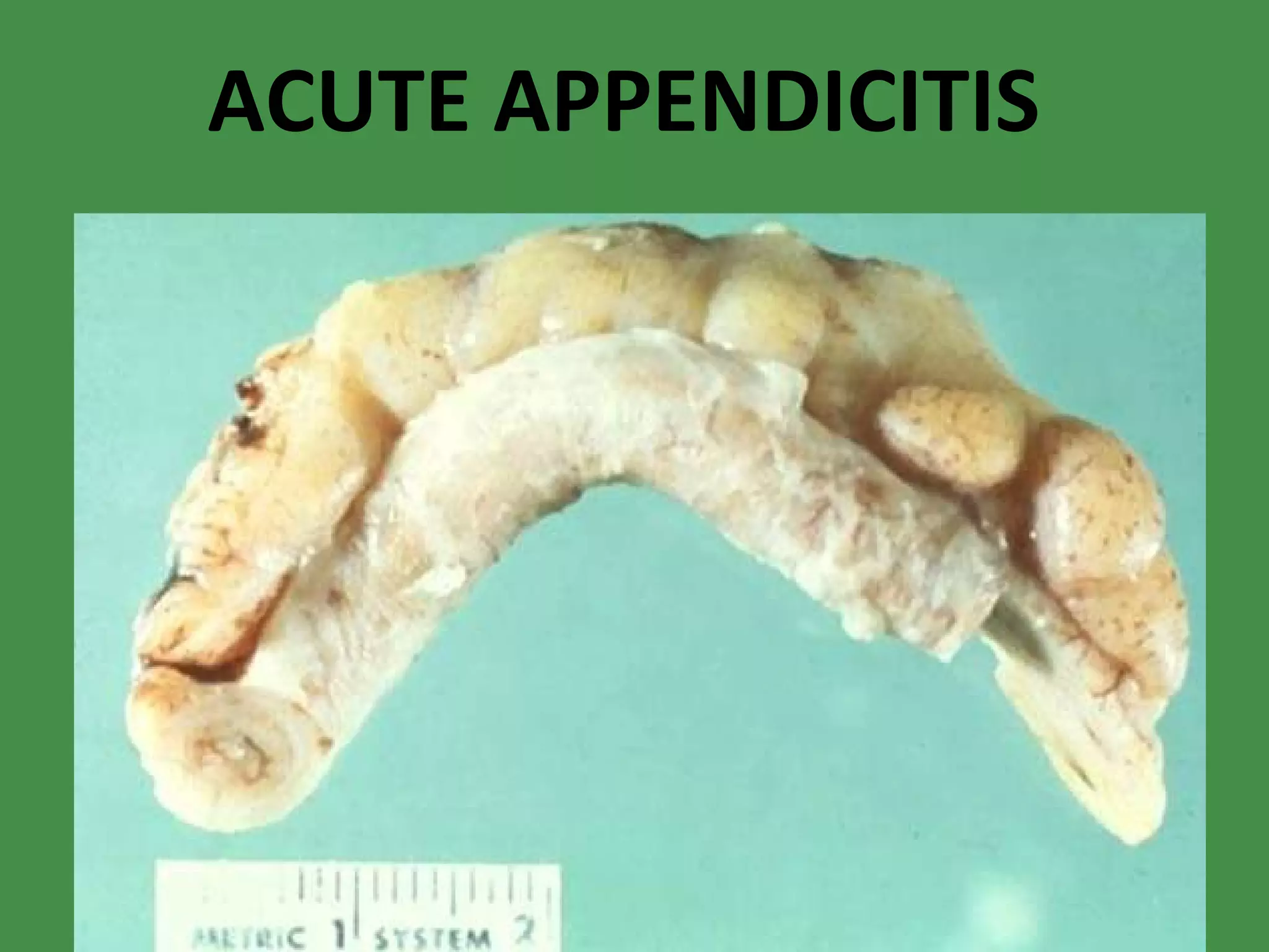 ACUTE APPENDICITIS 