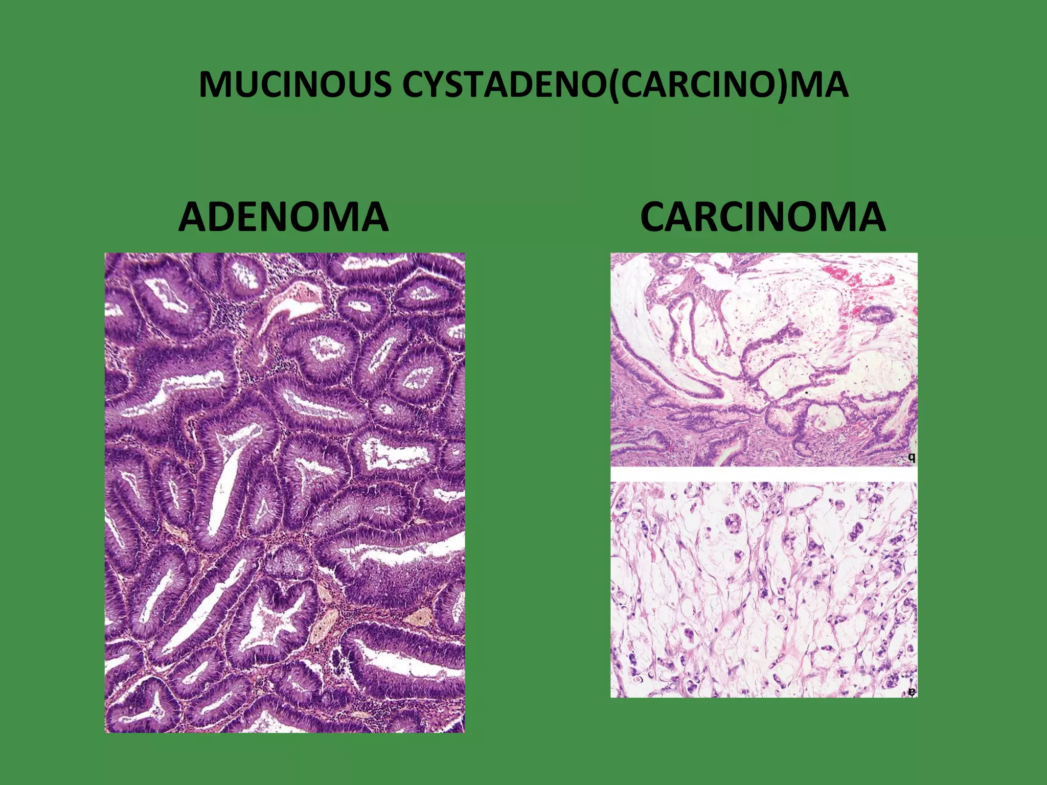 MUCINOUS CYSTADENO(CARCINO)MA ADENOMA CARCINOMA 