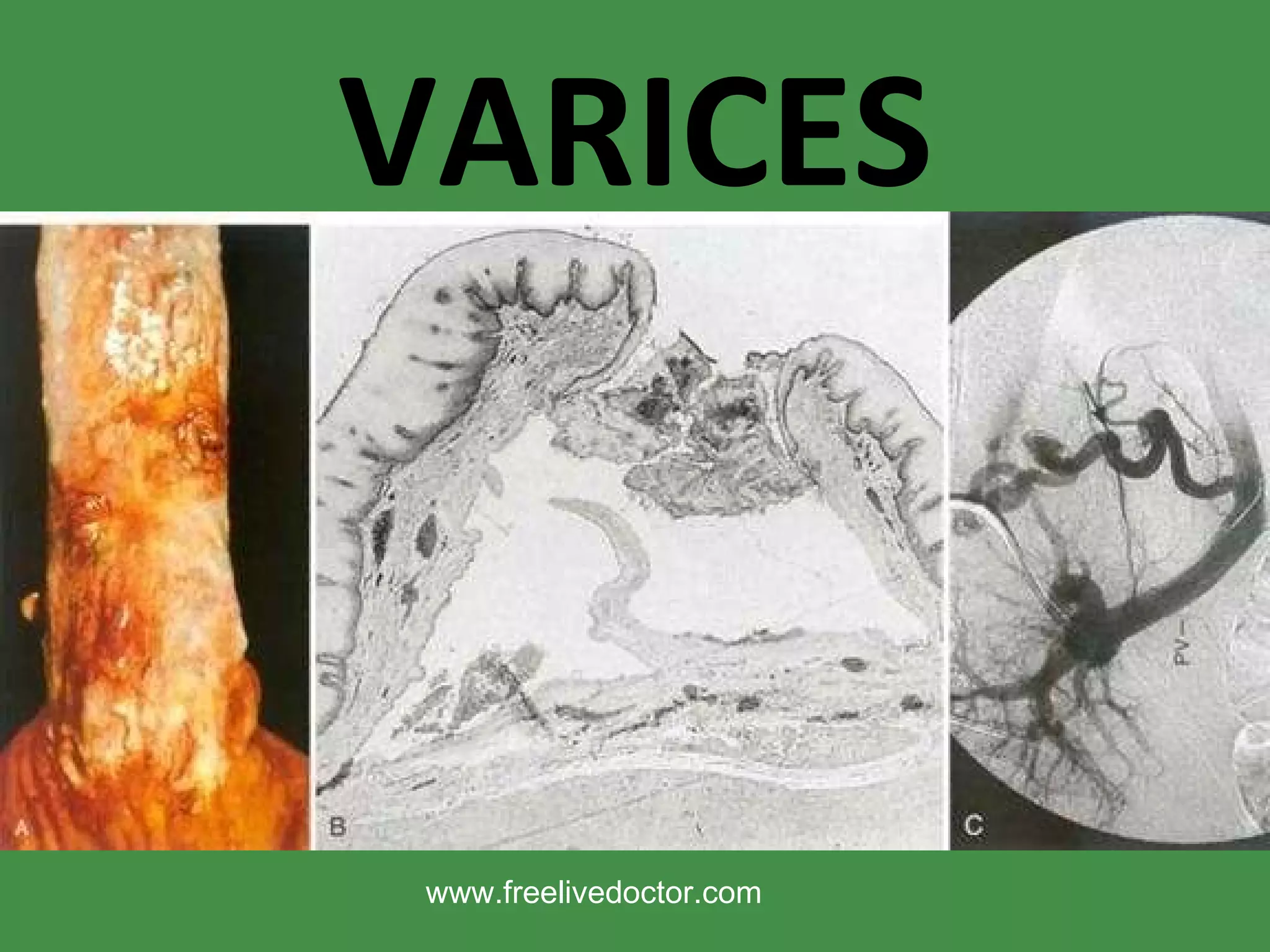VARICES www.freelivedoctor.com 