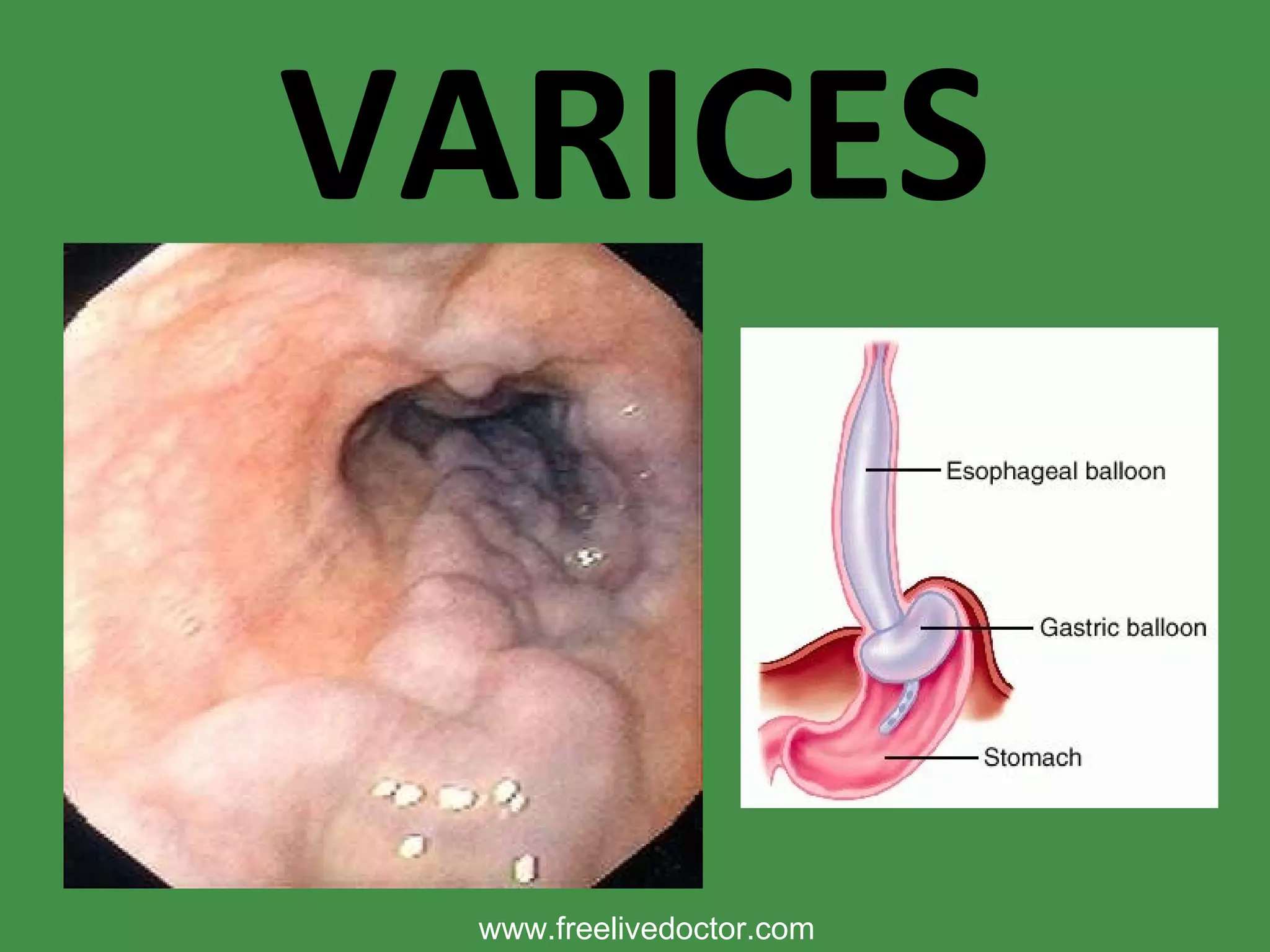 VARICES www.freelivedoctor.com 