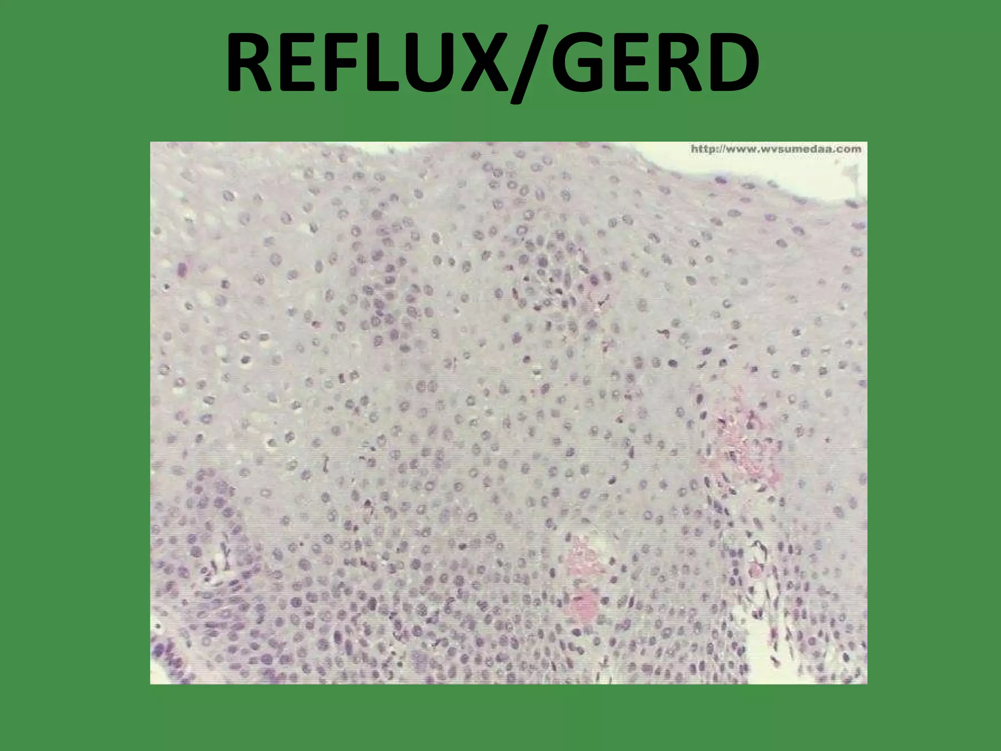 REFLUX/GERD 