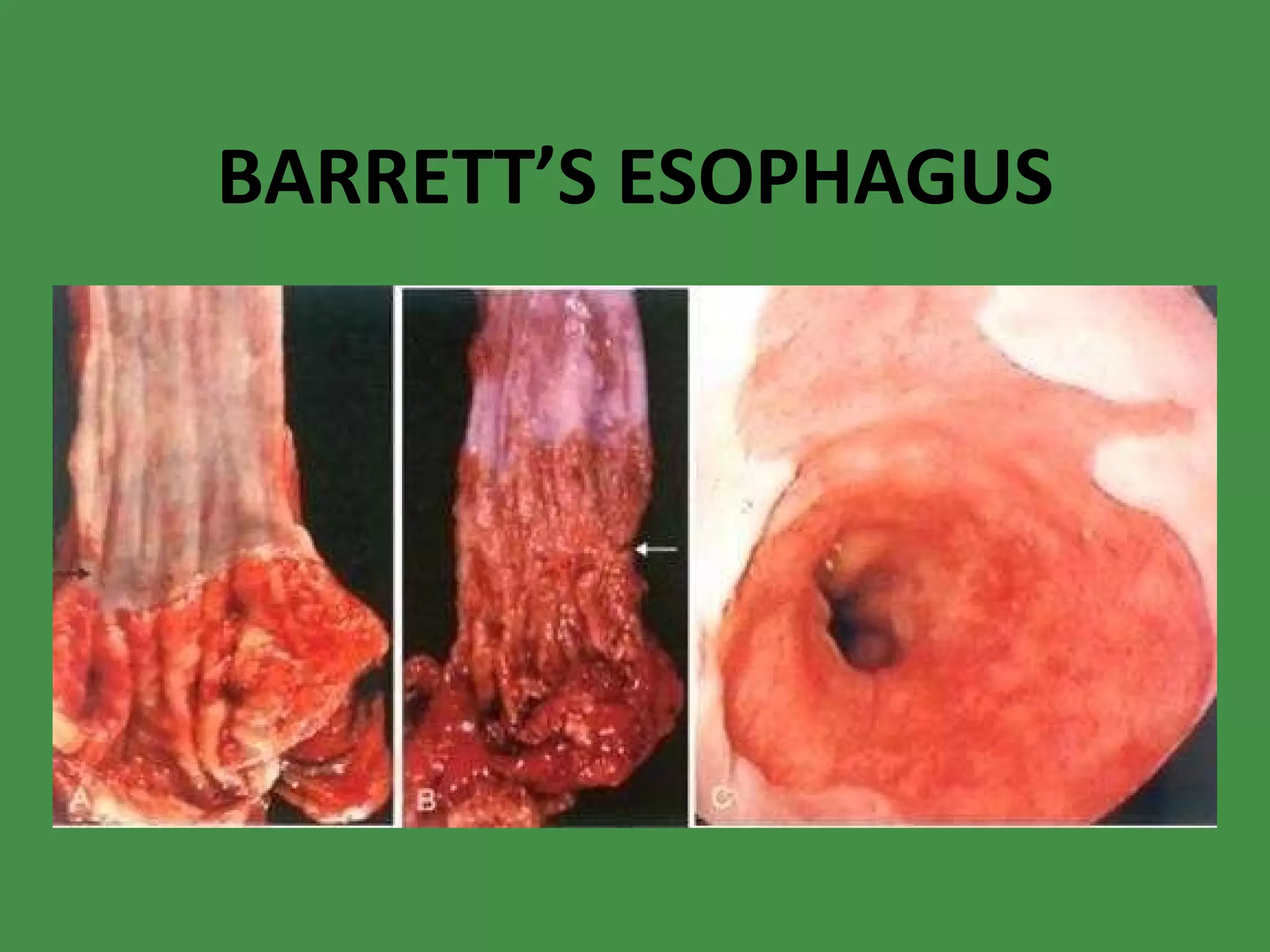 BARRETT’S ESOPHAGUS 