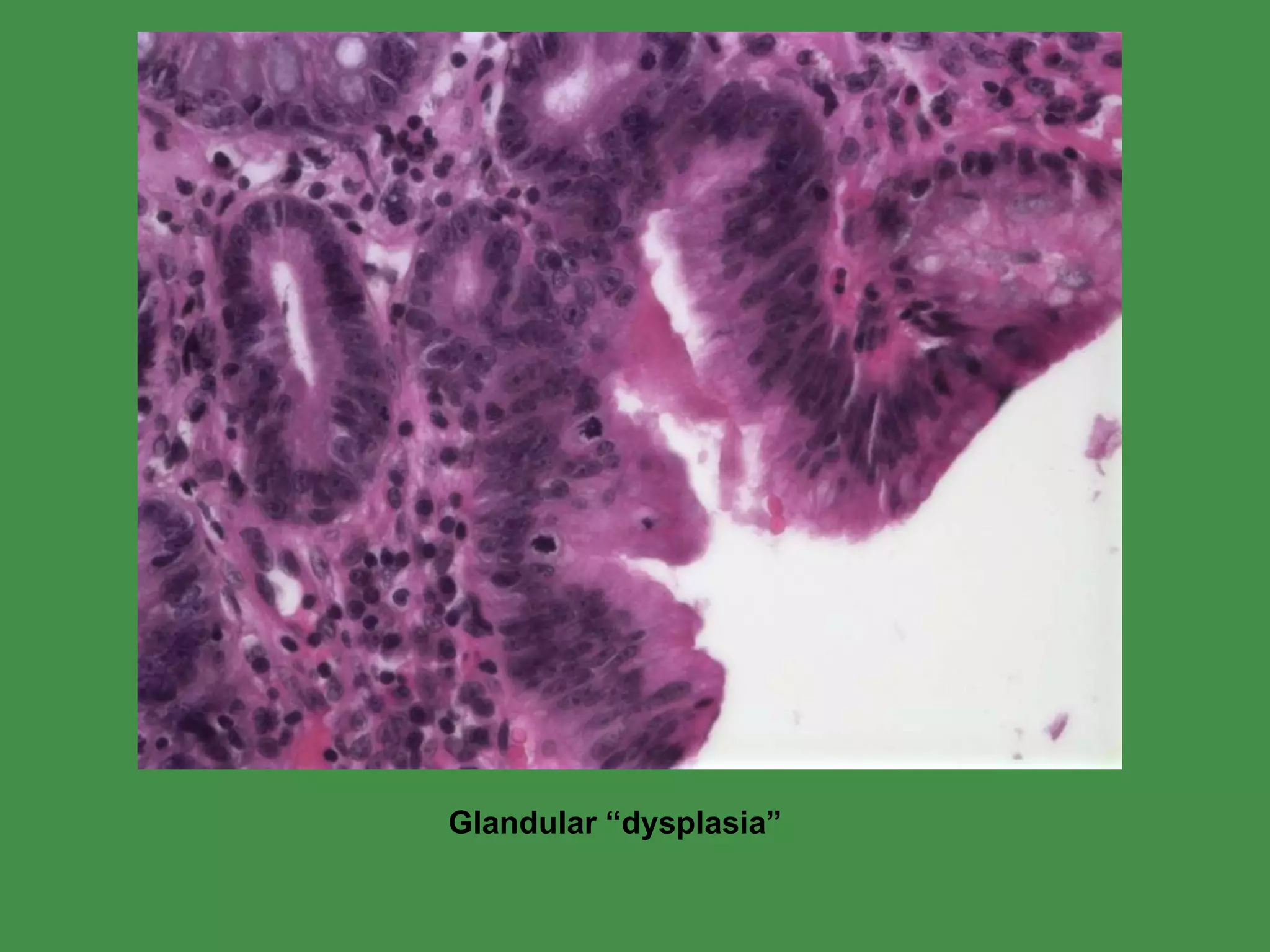 Glandular “dysplasia” 
