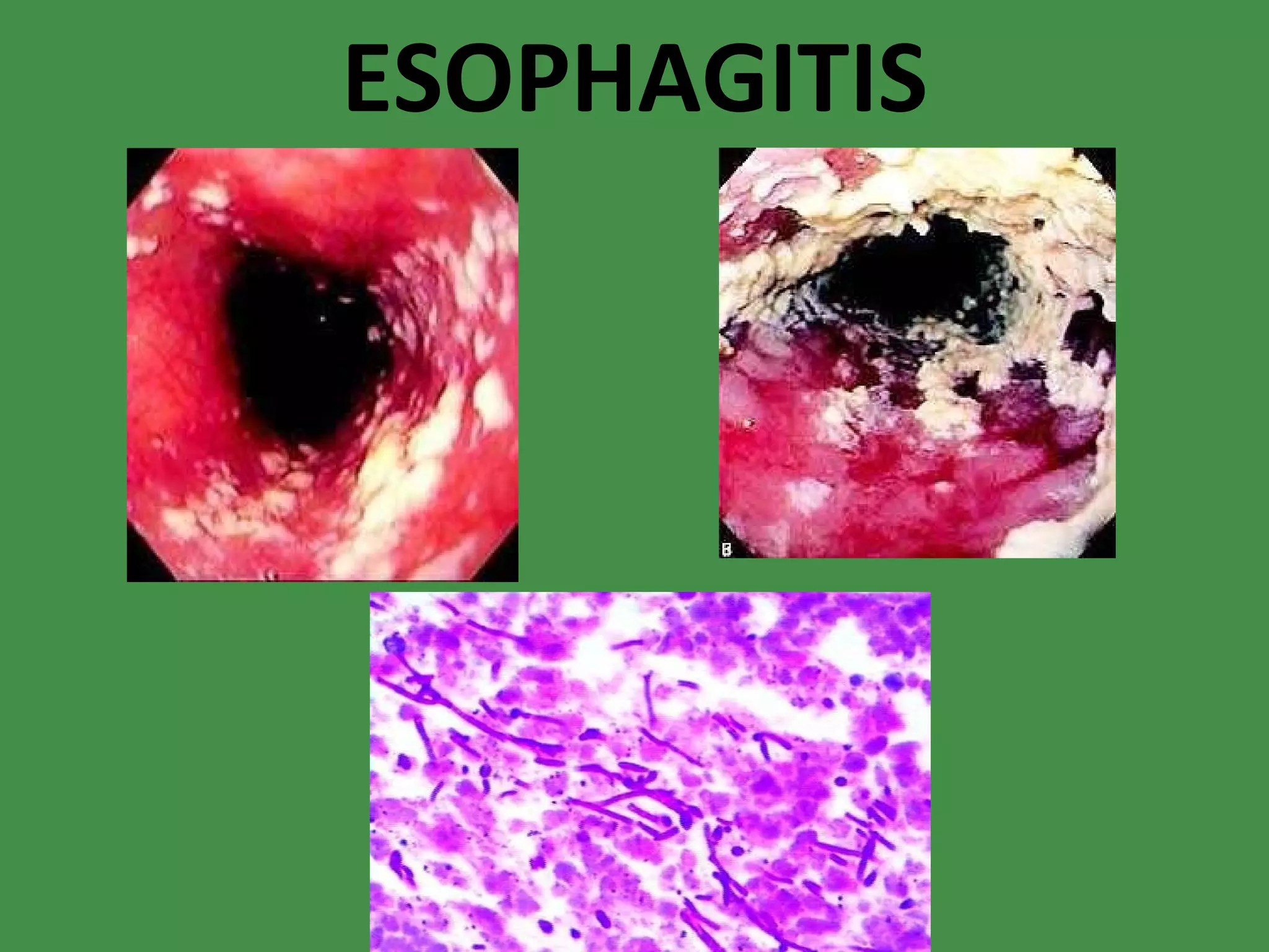ESOPHAGITIS 