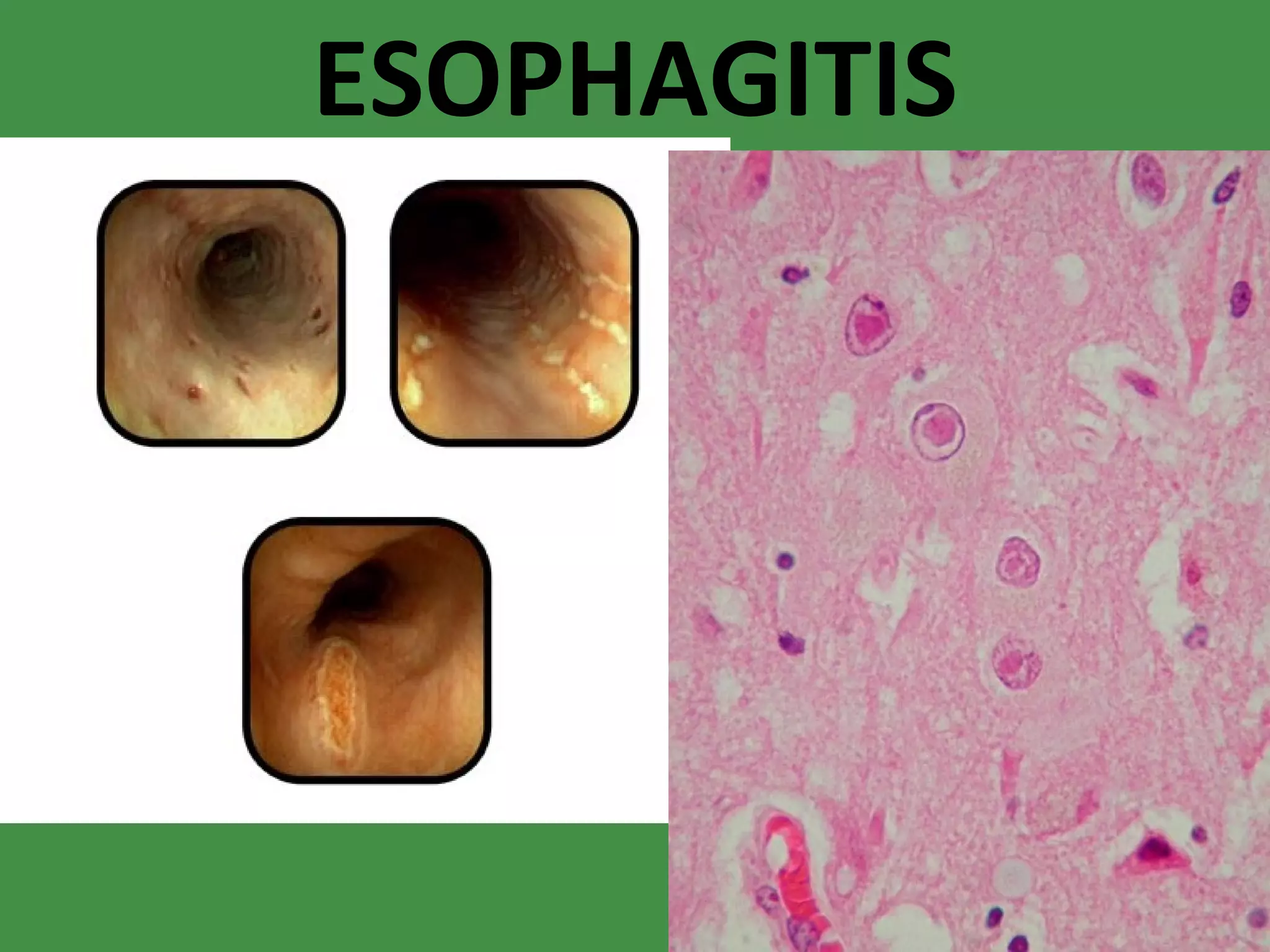 ESOPHAGITIS 