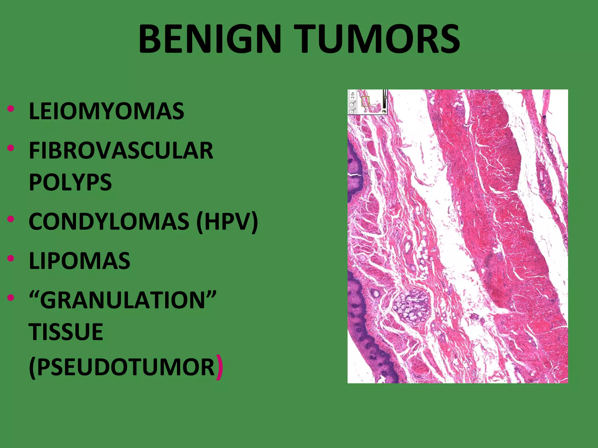 BENIGN TUMORS LEIOMYOMAS FIBROVASCULAR POLYPS CONDYLOMAS (HPV) ‏ LIPOMAS “ GRANULATION” TISSUE (PSEUDOTUMOR ) ‏ 