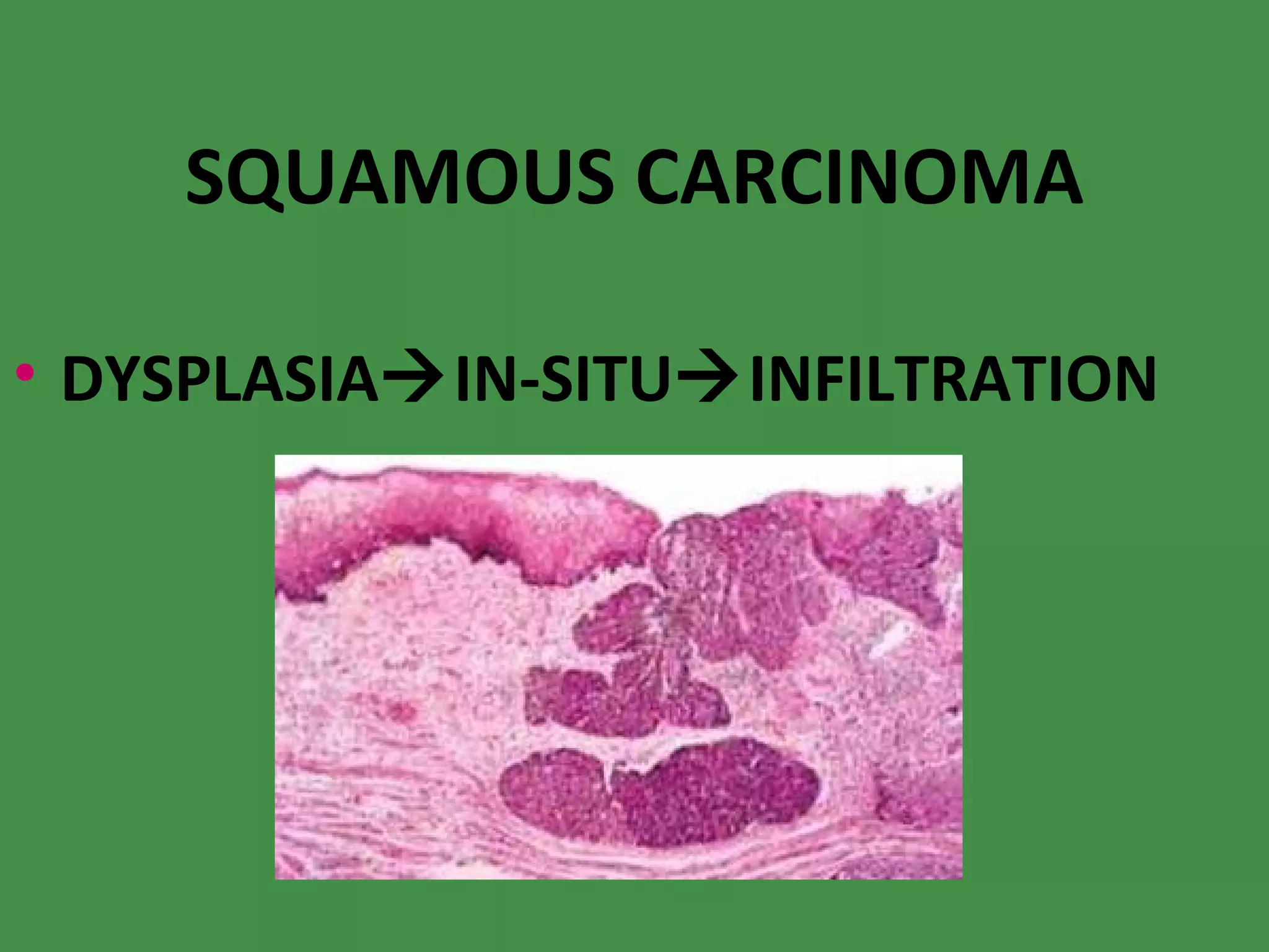 SQUAMOUS CARCINOMA DYSPLASIA  IN-SITU  INFILTRATION 