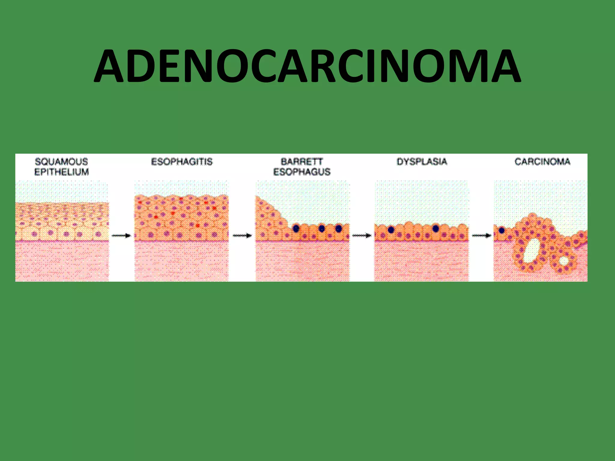 ADENOCARCINOMA 