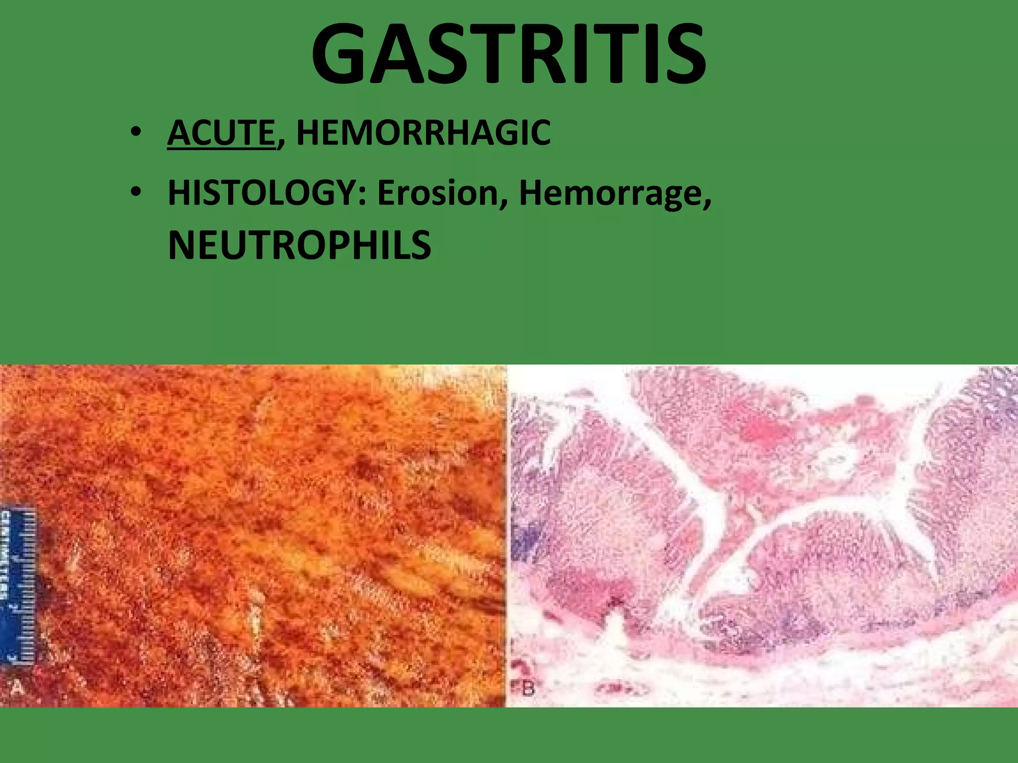 GASTRITIS ACUTE , HEMORRHAGIC HISTOLOGY: Erosion, Hemorrage,  NEUTROPHILS 