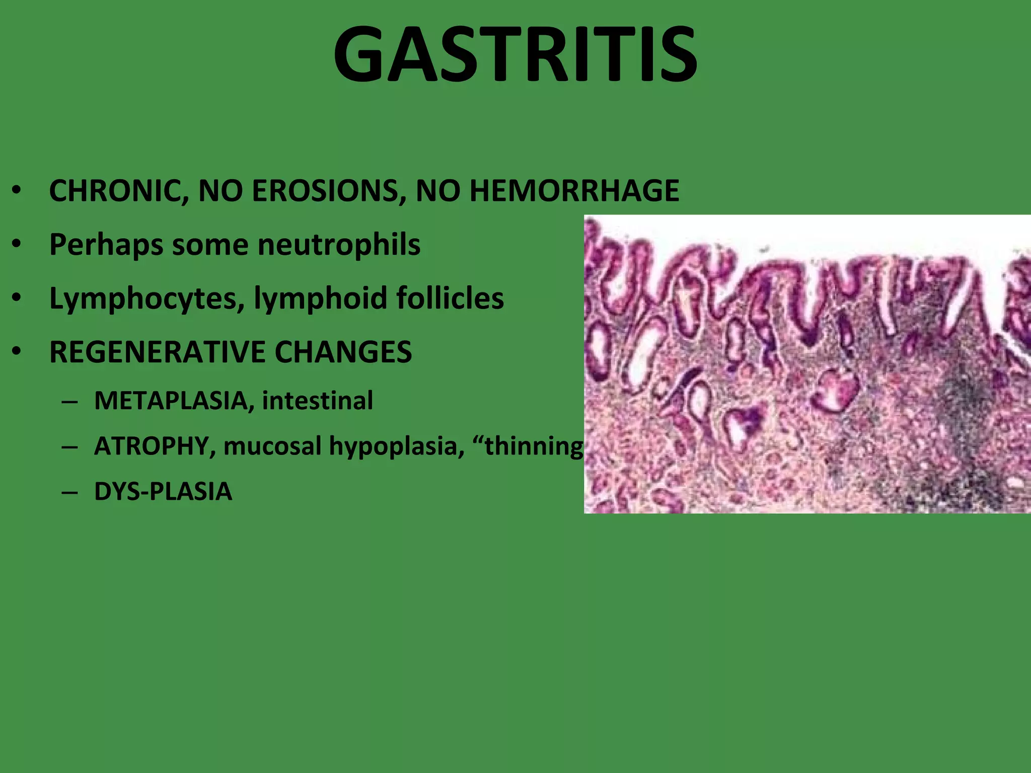 GASTRITIS CHRONIC, NO EROSIONS, NO HEMORRHAGE Perhaps some neutrophils Lymphocytes, lymphoid follicles REGENERATIVE CHANGES METAPLASIA, intestinal ATROPHY, mucosal hypoplasia, “thinning” DYS-PLASIA 