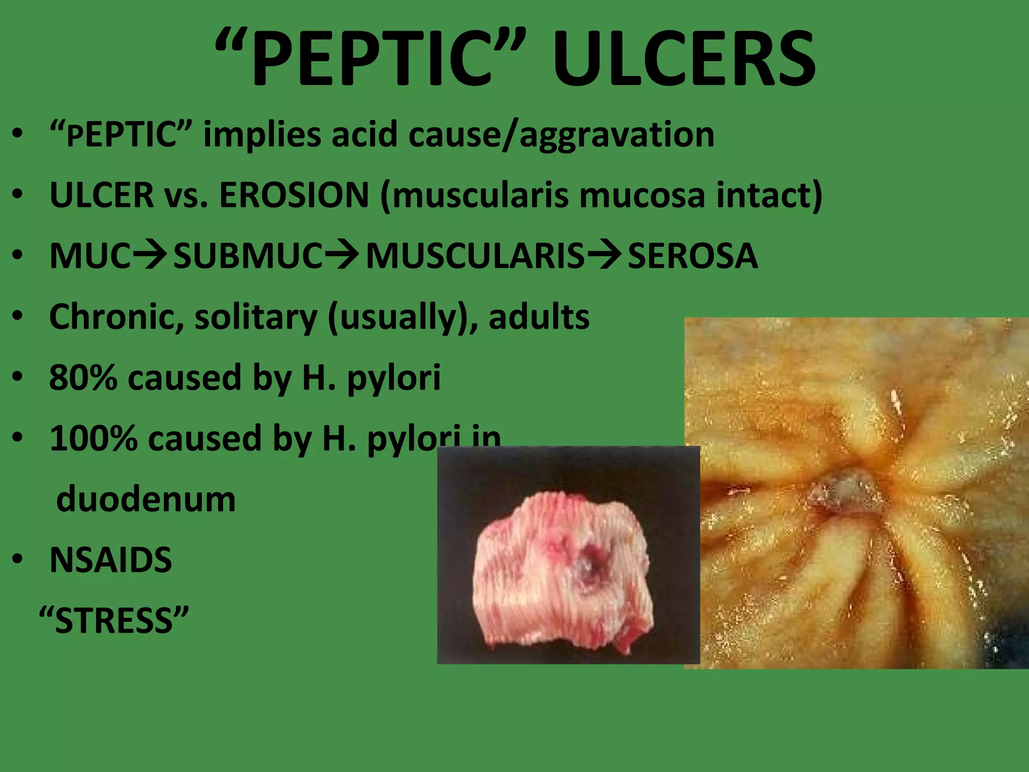 “ PEPTIC” ULCERS “ P EPTIC” implies acid cause/aggravation ULCER vs. EROSION (muscularis mucosa intact) MUC  SUBMUC  MUSCULARIS  SEROSA Chronic, solitary (usually), adults 80% caused by H. pylori 100% caused by H. pylori in duodenum NSAIDS “ STRESS” 