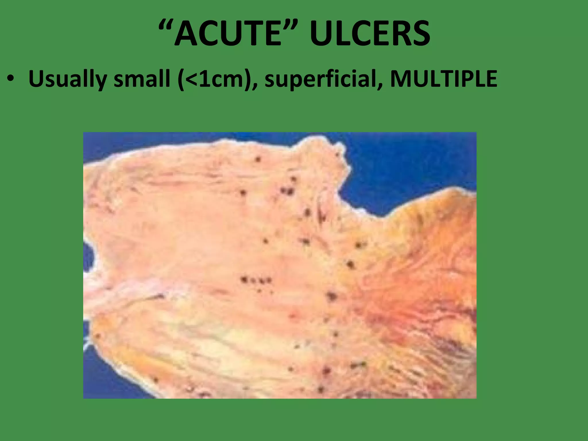 “ ACUTE” ULCERS Usually small (<1cm), superficial, MULTIPLE 