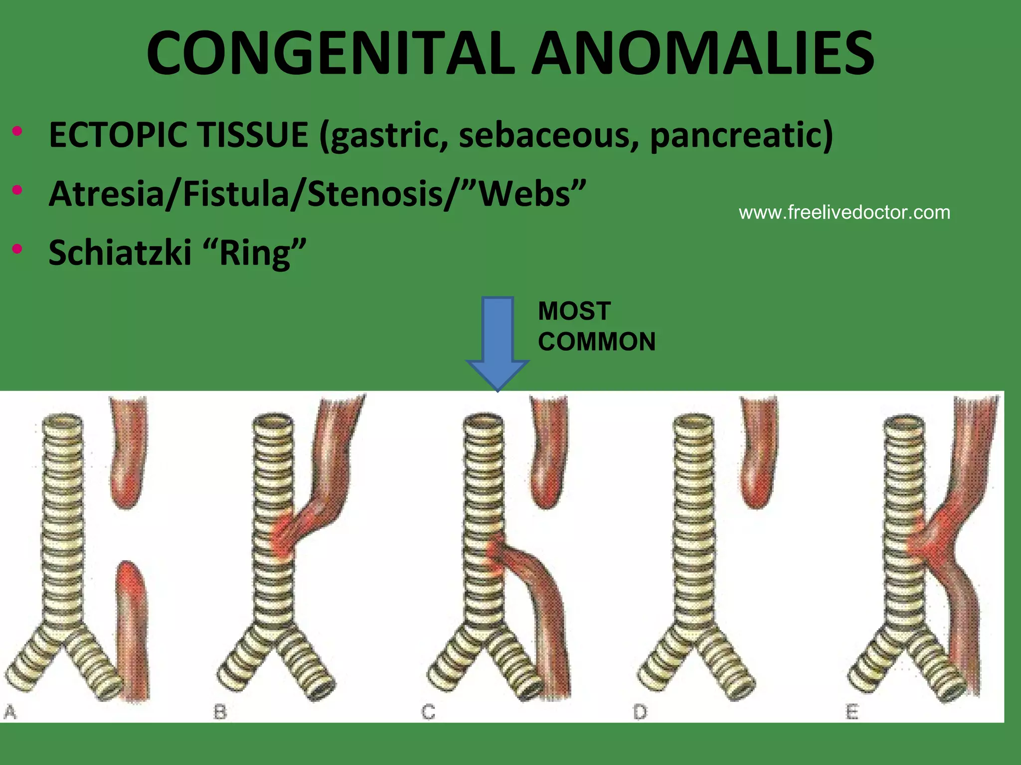 CONGENITAL ANOMALIES ECTOPIC TISSUE (gastric, sebaceous, pancreatic) ‏ Atresia/Fistula/Stenosis/”Webs” Schiatzki “Ring” MOST COMMON www.freelivedoctor.com 