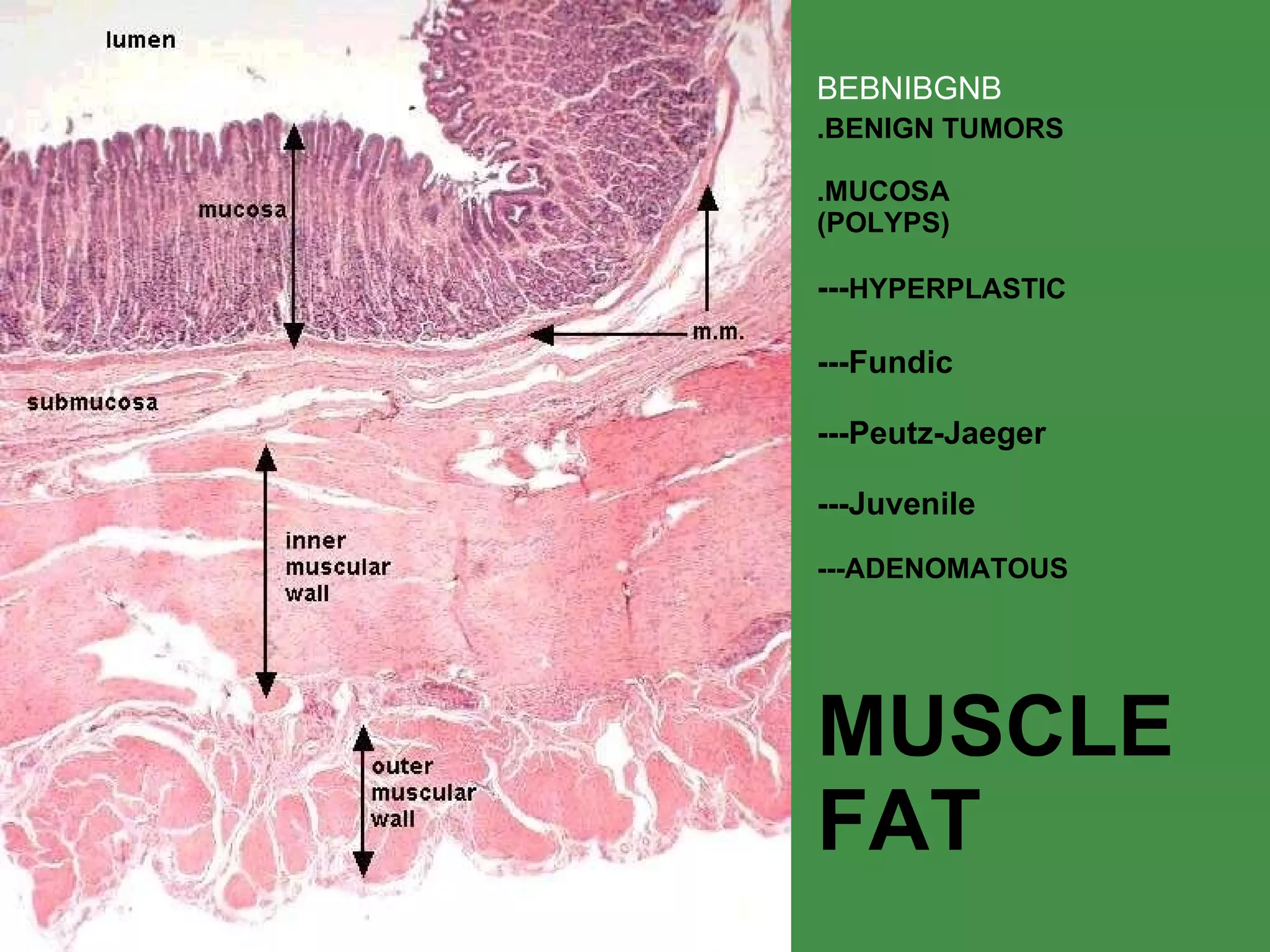 BEBNIBGNB .BENIGN TUMORS .MUCOSA (POLYPS) --- HYPERPLASTIC ---Fundic ---Peutz-Jaeger ---Juvenile ---ADENOMATOUS MUSCLE FAT 