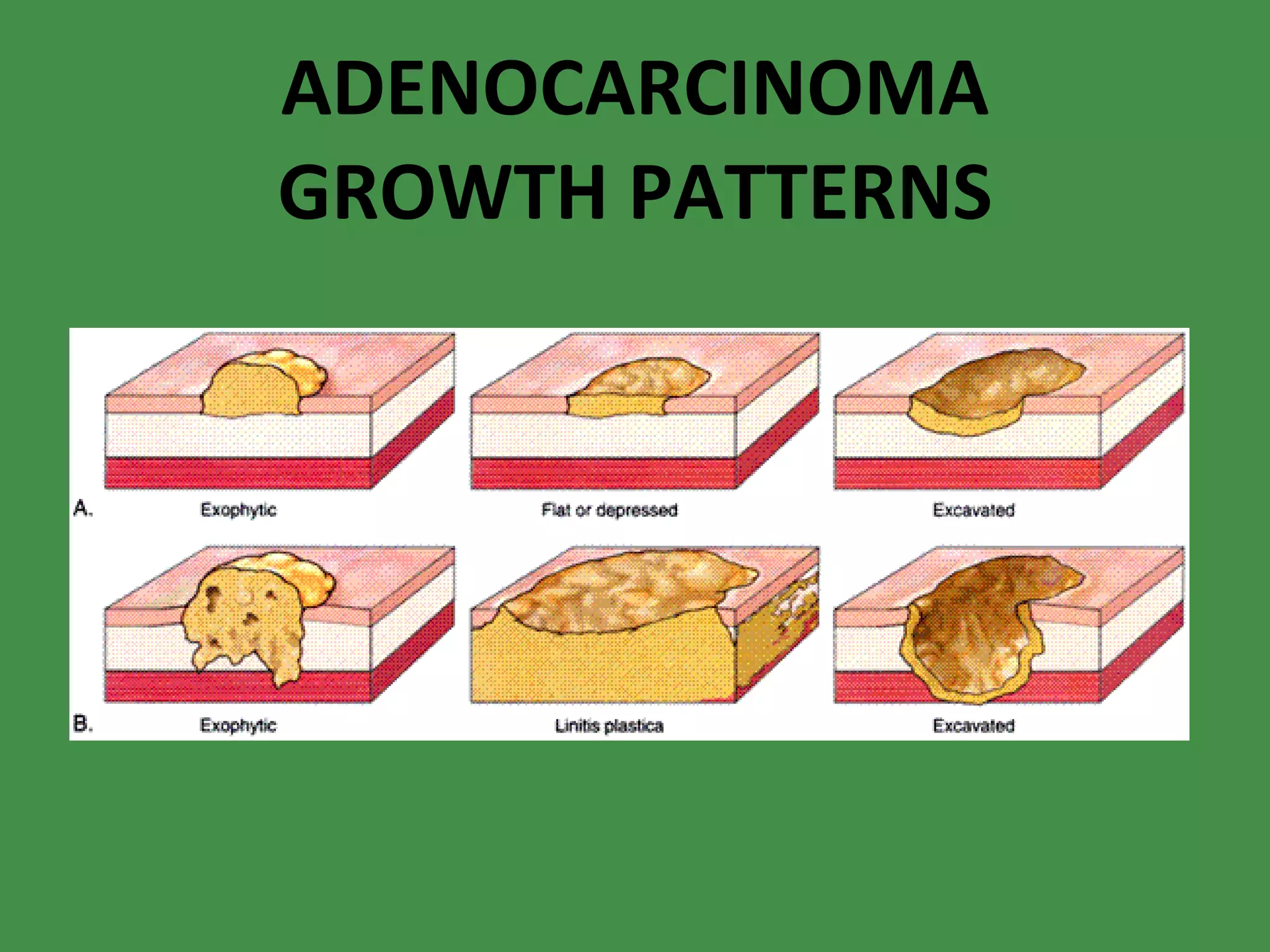 ADENOCARCINOMA GROWTH PATTERNS 