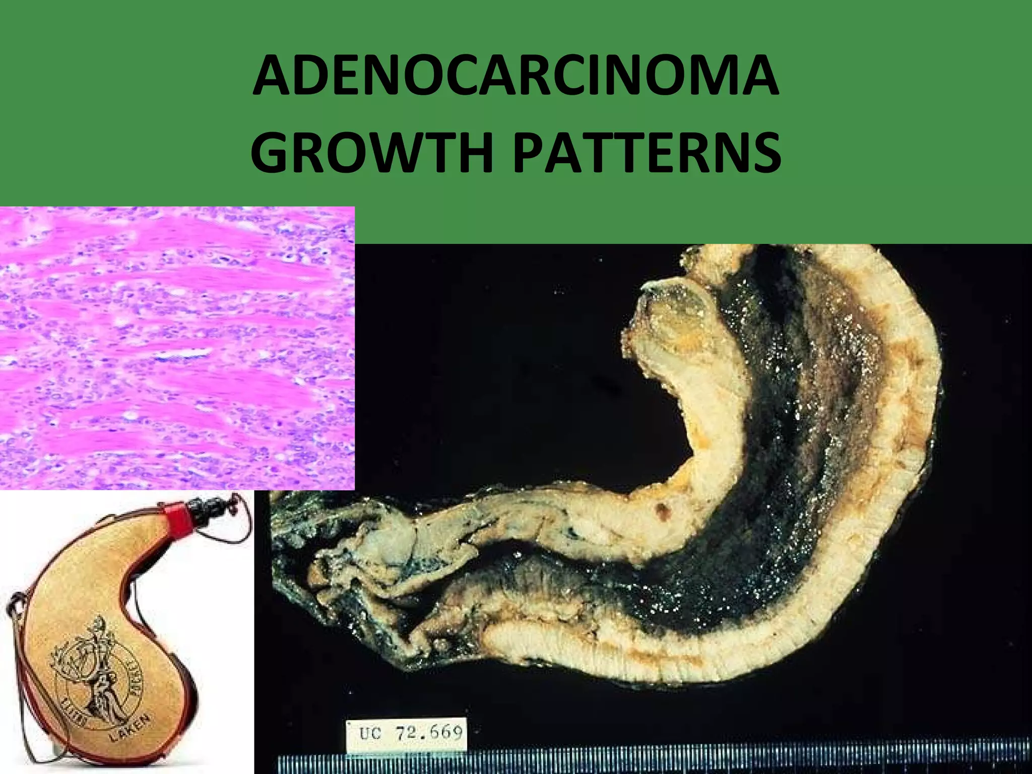ADENOCARCINOMA GROWTH PATTERNS 