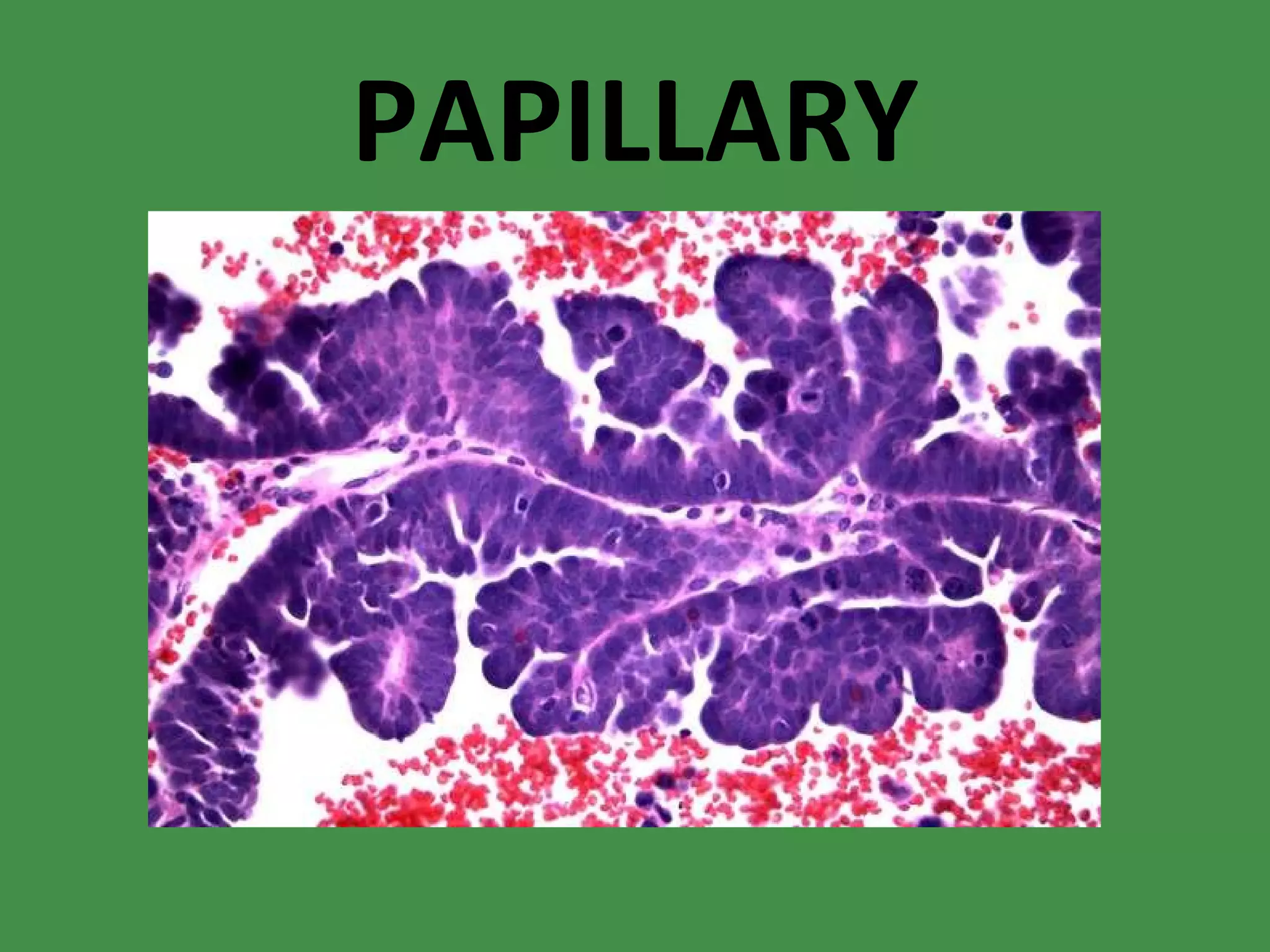 PAPILLARY 