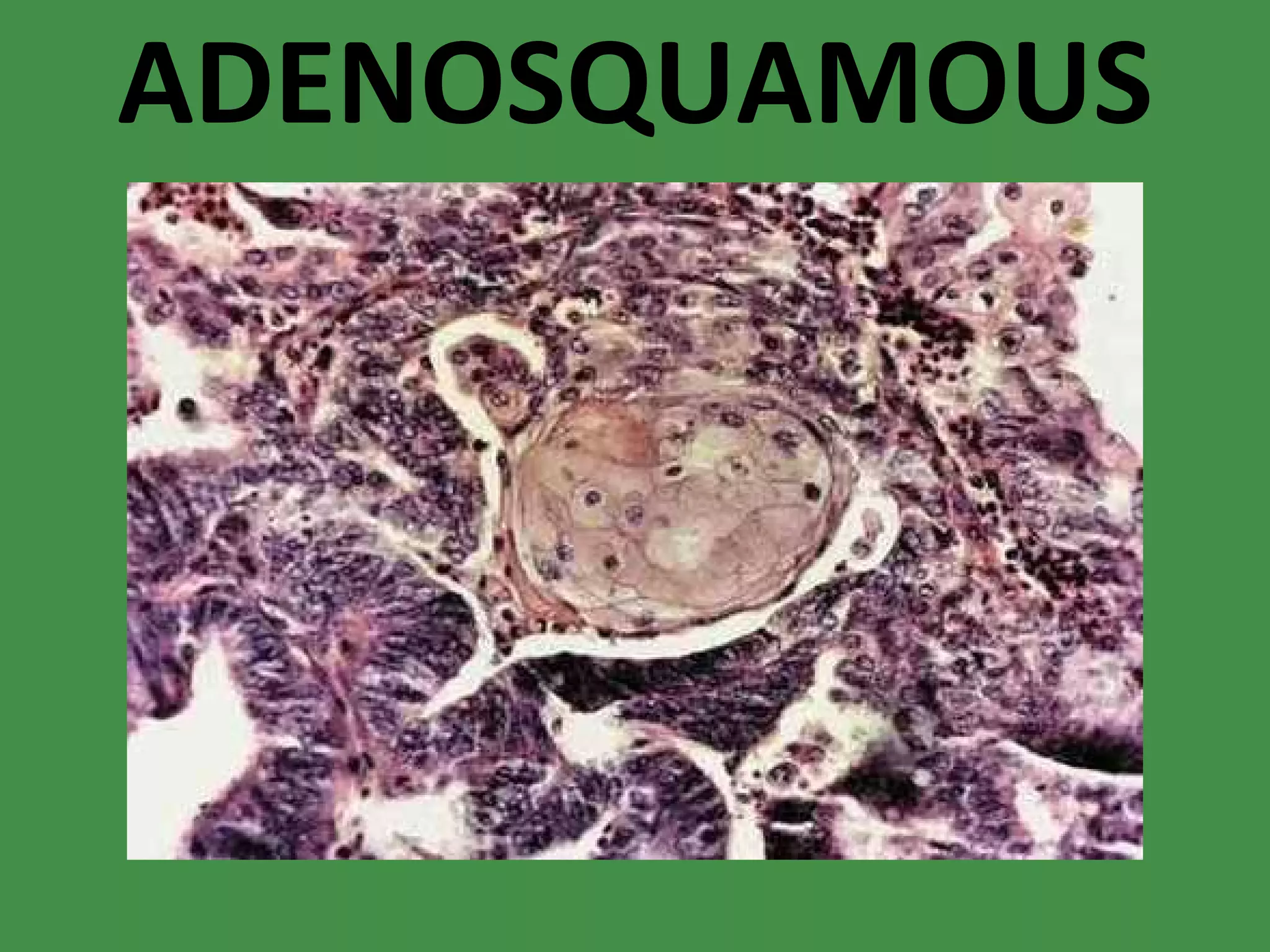 ADENOSQUAMOUS 