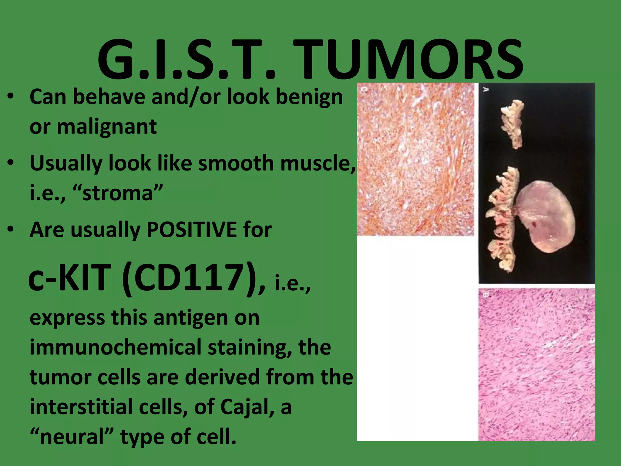 G.I.S.T. TUMORS Can behave and/or look benign or malignant Usually look like smooth muscle, i.e., “stroma” Are usually POSITIVE for  c-KIT (CD117) ,  i.e., express this antigen on immunochemical staining, the tumor cells are derived from the interstitial cells, of Cajal, a “neural” type of cell. 