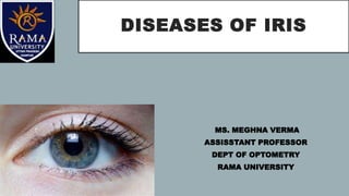 DISEASES OF IRIS
MS. MEGHNA VERMA
ASSISSTANT PROFESSOR
DEPT OF OPTOMETRY
RAMA UNIVERSITY
 