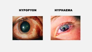 HYPOPYON HYPHAEMA
 