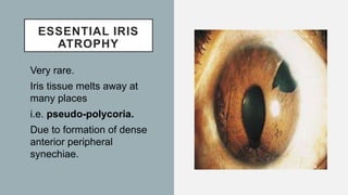 ESSENTIAL IRIS
ATROPHY
Very rare.
Iris tissue melts away at
many places
i.e. pseudo-polycoria.
Due to formation of dense
anterior peripheral
synechiae.
 