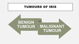 TUMOURS OF IRIS
BENIGN
TUMOUR MALIGNANT
TUMOUR
 