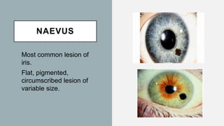 NAEVUS
Most common lesion of
iris.
Flat, pigmented,
circumscribed lesion of
variable size.
 